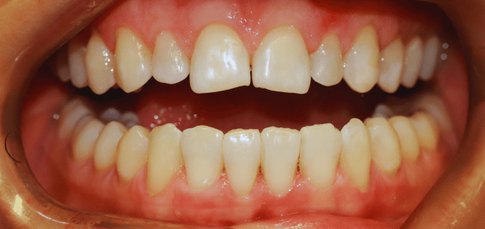 Before - Merrow Park Dental 