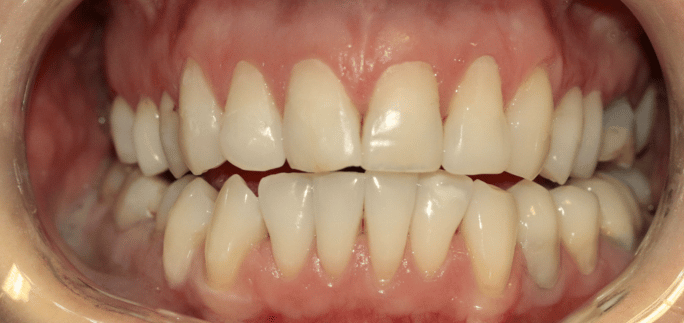 After - Merrow Park Dental 